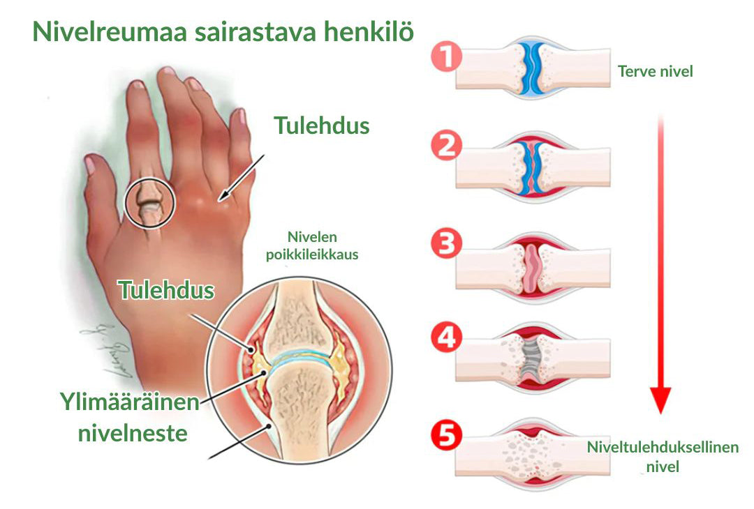 🔥Virallinen myymälä: Ourlyard® Chillflex Mint Kipua Lievittävä Voide (Hoito niveltulehdukseen, hermosärkyyn, reumasairauksiin, lihaskramppeihin, nykimisiin ja urheiluvammoihin)