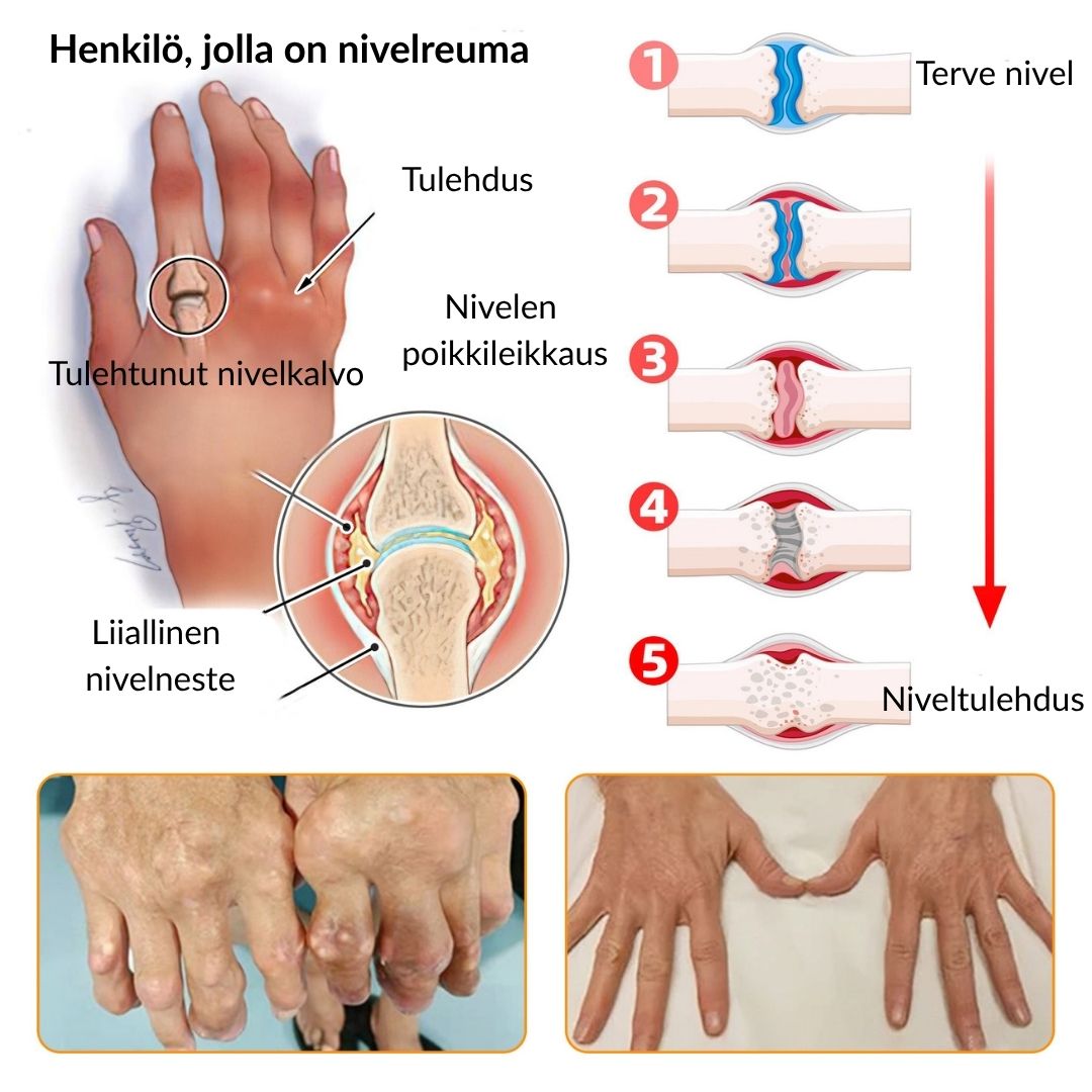 ⚡📢Ourlyard® Botuliinitoksiini ja Mehiläismyrkky Kipua Lievittävä ja Luita Parantava Kaksivaikutteinen Rauhoittava Voide