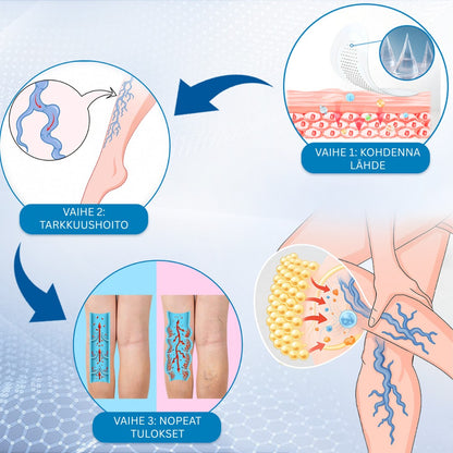🔥Aikarajoitettu tarjous – Ourlyard® Vein Ease -mikroneulahoitolaastari – leikattava (hämähäkkisuonille, suonikohjuille, turvotukseen ja jalkojen väsymykseen)