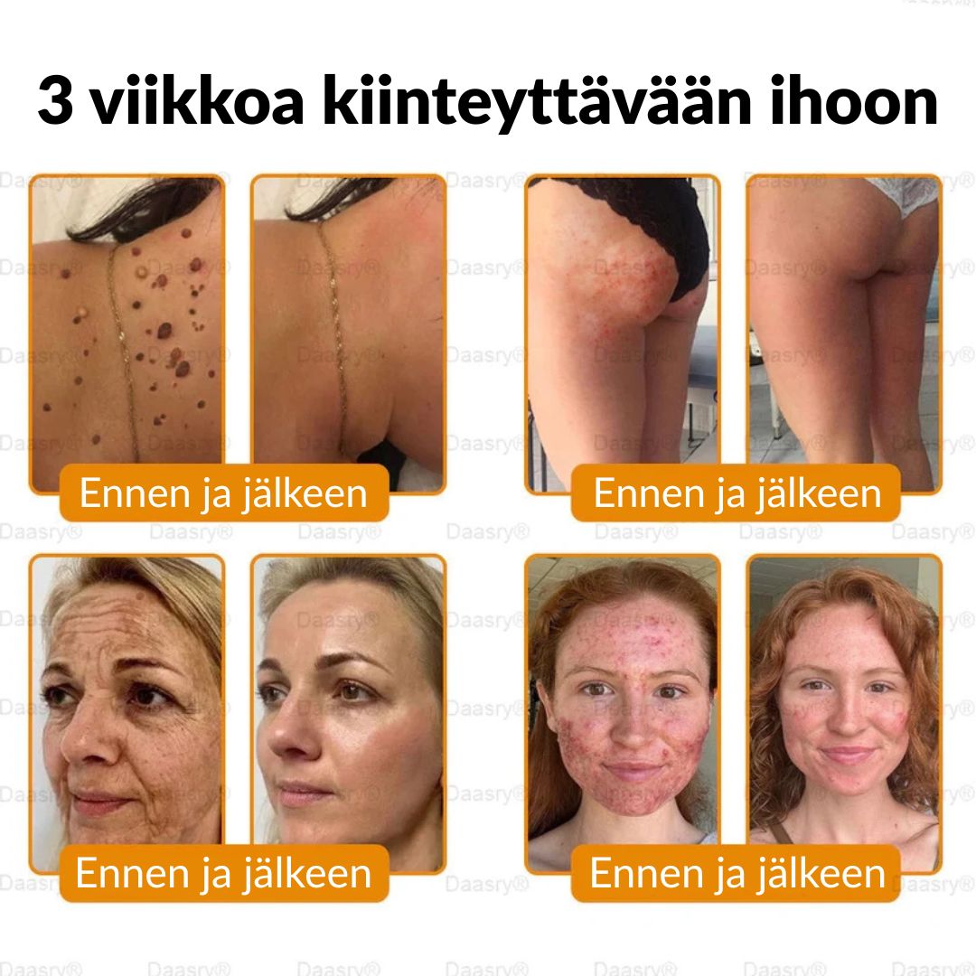 Ourlyard® Botox Mehiläismyrkky Ihon Uudistusvoide – Ikääntymisen merkkien vähentäjä, Kosteuttava, Ihoa kiinteyttävä ja kohottava, Ihon korjaava, Tasaisen sävyn edistäjä, Aknen ja tummien läiskien hoito, Syylien ja luomien poisto sekä Psoriaasin lievitys.