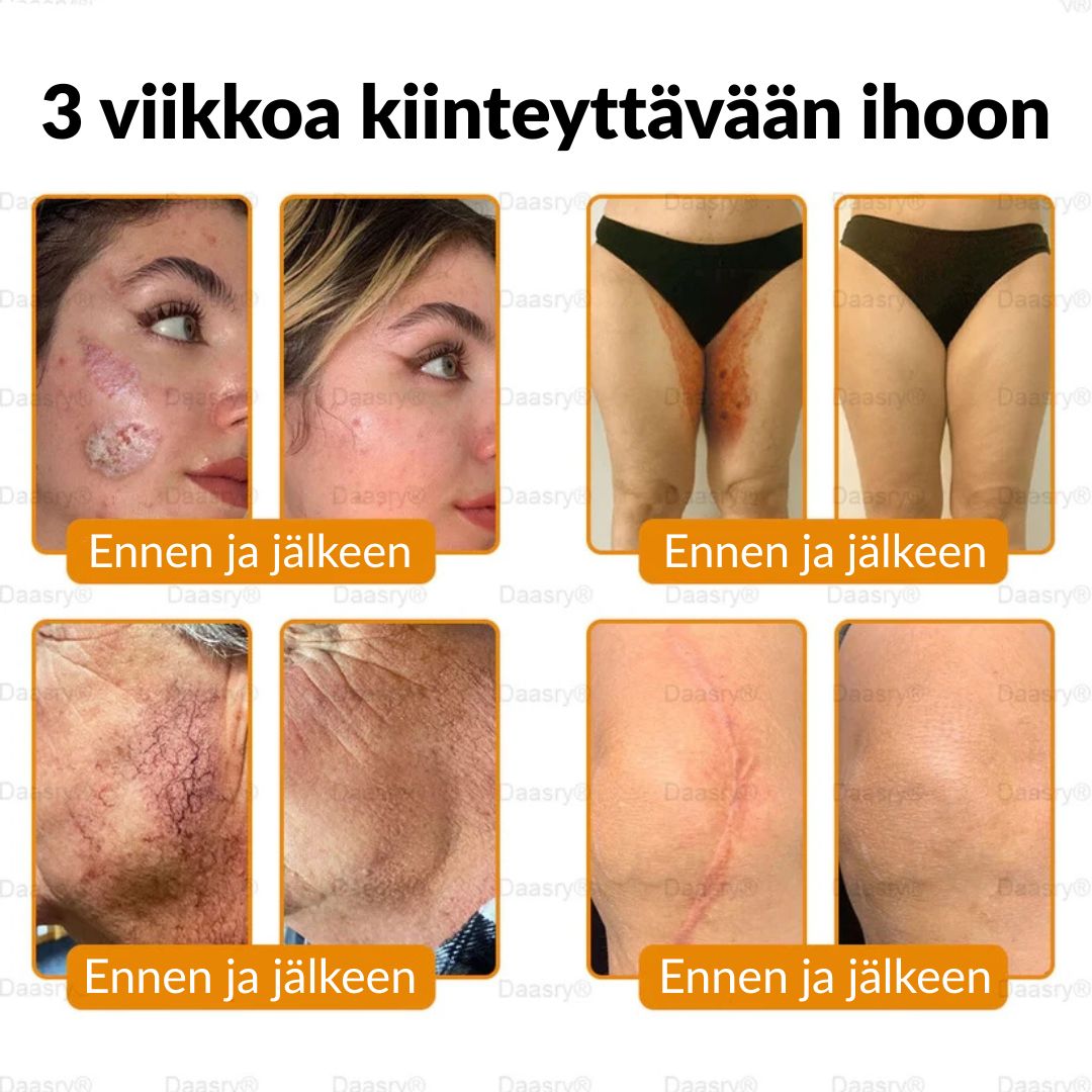 Ourlyard® Botox Mehiläismyrkky Ihon Uudistusvoide – Ikääntymisen merkkien vähentäjä, Kosteuttava, Ihoa kiinteyttävä ja kohottava, Ihon korjaava, Tasaisen sävyn edistäjä, Aknen ja tummien läiskien hoito, Syylien ja luomien poisto sekä Psoriaasin lievitys.